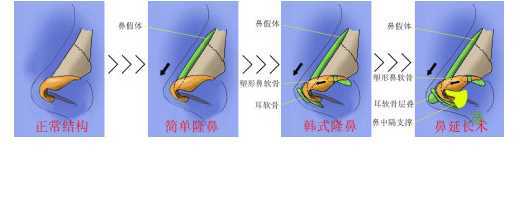 鼻部整形常见问题解答: