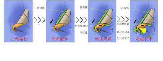 鼻部整形常见问题解答：