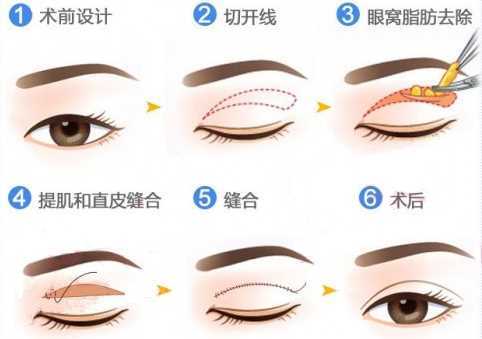 双眼皮手术多宽合适?