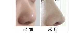 鼻头大怎么办?