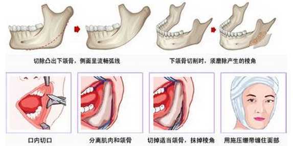 改方脸型用什么方法好?