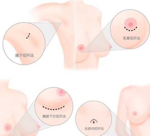 假体隆胸的切口方式有哪些？