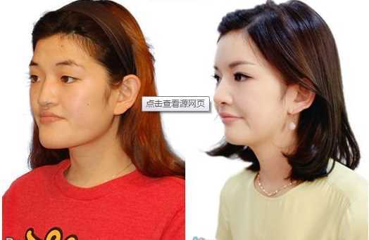 正颌手术的后遗症