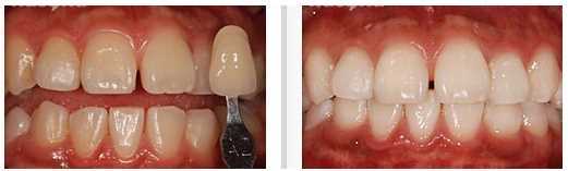 激光美白牙齿有没有副作用?