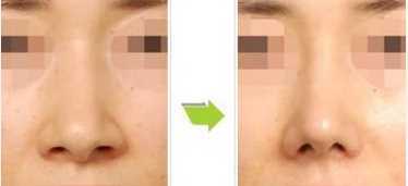 鼻头缩小术的手术过程是怎样的？