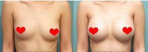 两种矫正乳房下垂的方法