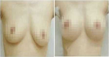 乳房下垂矫正手术禁忌症有哪些?