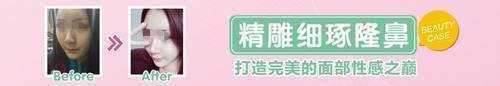上海第九人民医院隆鼻多少钱?