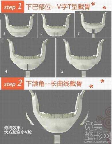 V-line磨骨术手术过程介绍