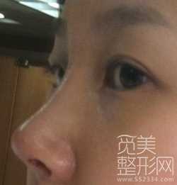 硅胶隆鼻+自体耳软骨垫鼻尖整形后日记分享