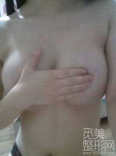 es假体隆胸术后2个月