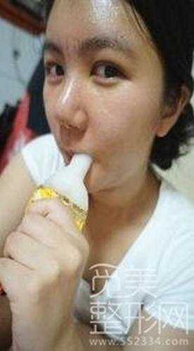 双眼皮+硅胶隆鼻+自体脂肪丰额头整形1年后