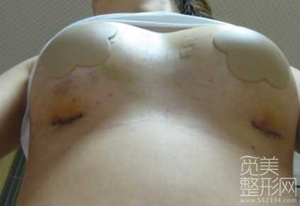 水滴形假体隆胸手术后形3天的照片