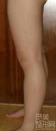 6个月后的吸脂瘦腹部+吸脂瘦大腿