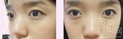 硅胶隆鼻3个月后每天都美美哒