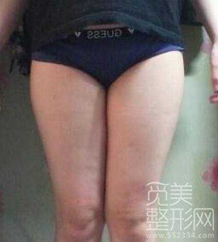 大腿吸脂术后两周啦~