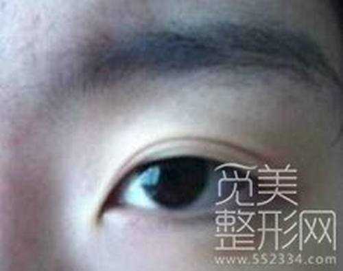 下吧矫正 磨颧骨 自体脂肪填充 开眼角 全切双眼