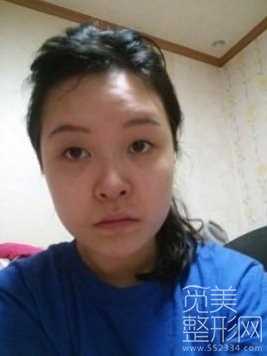 双眼皮+磨颧骨+下巴矫正术后两个月
