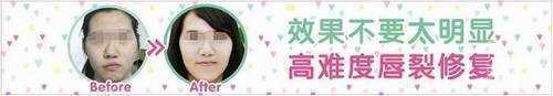 西安西京医院唇裂修复怎么样?费用多少钱?