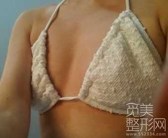 乳房下垂矫正+水滴形假体隆胸术后４个月后