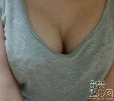 乳房下垂矫正+水滴形假体隆胸术后４个月后