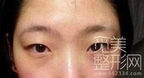 韩式三点双眼皮+开内眼角6个月后照片