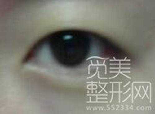 韩式三点双眼皮+开外眼角手术后3个月了