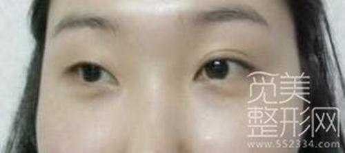 韩式三点双眼皮+开眼角5个月后照片