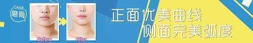 广州第一人民医院整形科哪个医生做磨骨好？案