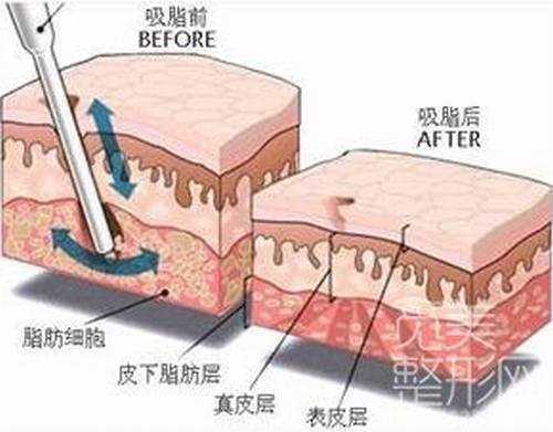 北京八大处医院吸脂多少钱？*果怎么样？