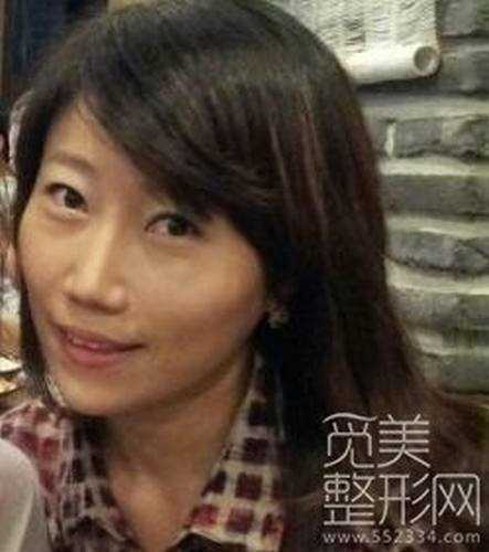 磨骨+隆鼻矫正3个月后