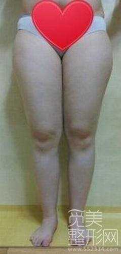大腿吸脂10个月后案例图