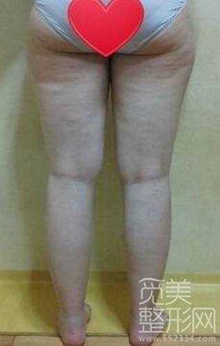 大腿吸脂10个月后案例图