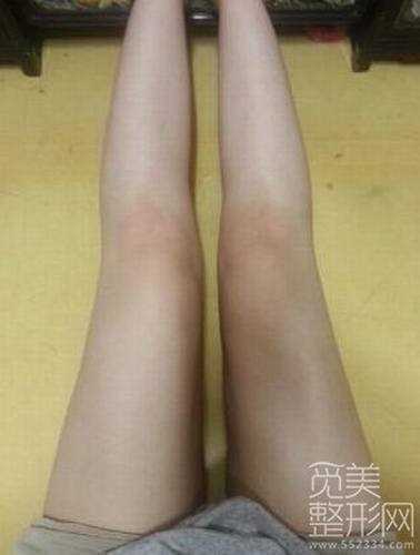 大腿吸脂10个月后案例图