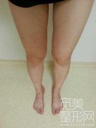 大腿吸脂整形十二个月后案例图