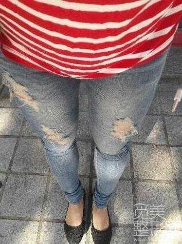 大腿吸脂4个月后案例