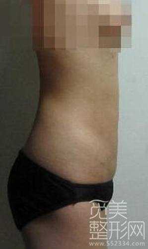 腹部吸脂手术2个月后案例图