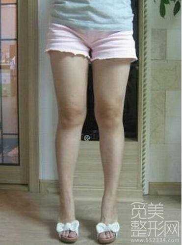 大腿吸脂整形手术案例