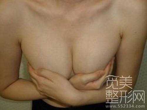 假体隆胸11个月后照片