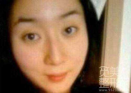 全切双眼皮案例图【*更多案例】 全切双眼皮两个月后照片