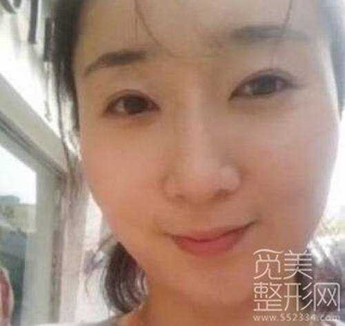 全切双眼皮案例图【*更多案例】 全切双眼皮两个月后照片