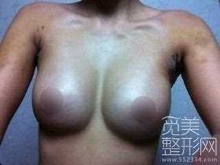 案例图水滴形假体隆胸整形手术1个月后