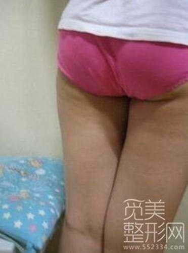 大腿吸脂术后十二个月案例图