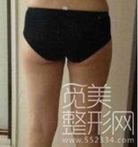 大腿吸脂整形手术六个月后照片