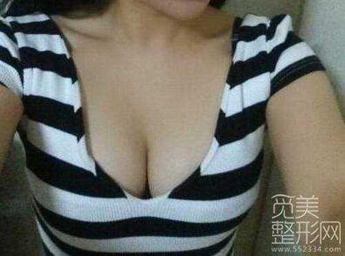 自体脂肪隆胸手术1个月后照片