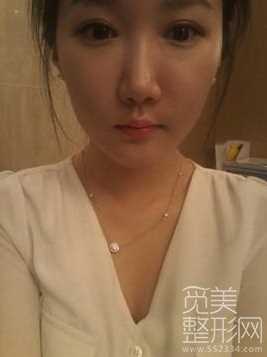 面部提升整形手术１周后