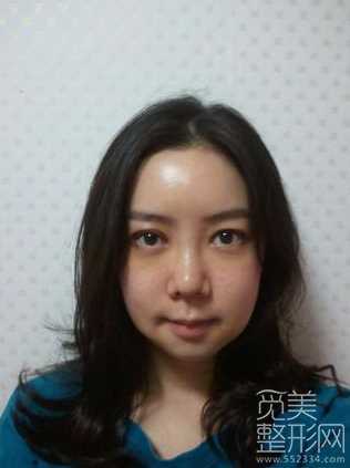 韩式三点双眼皮+硅胶隆鼻+面部填充2个月