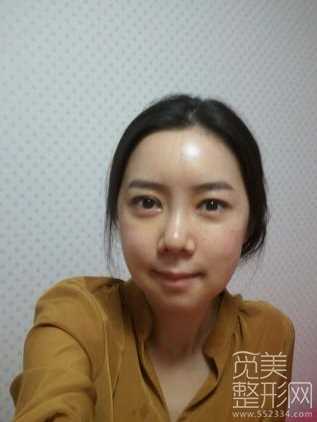 韩式三点双眼皮+硅胶隆鼻+面部填充2个月