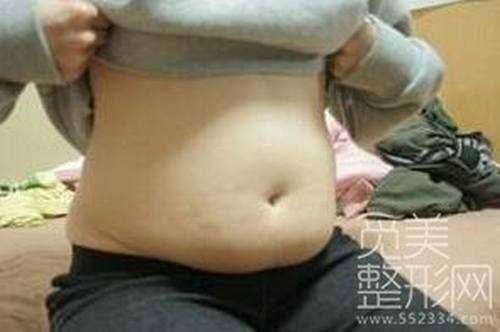 腹部吸脂手术３个月后