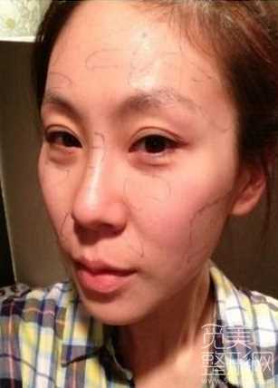 面部自体脂肪填充手术2个月后记